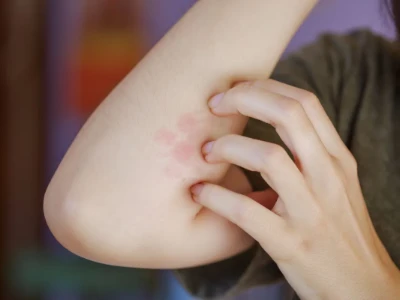 Brazo-con-enrojecimiento