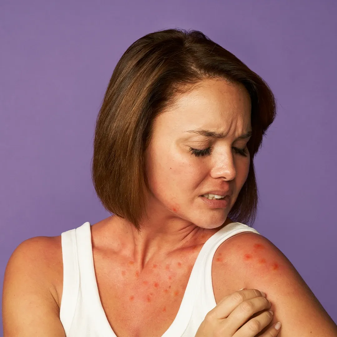 Eine Frau betrachtet eine Rötung auf ihrem Unterarm.